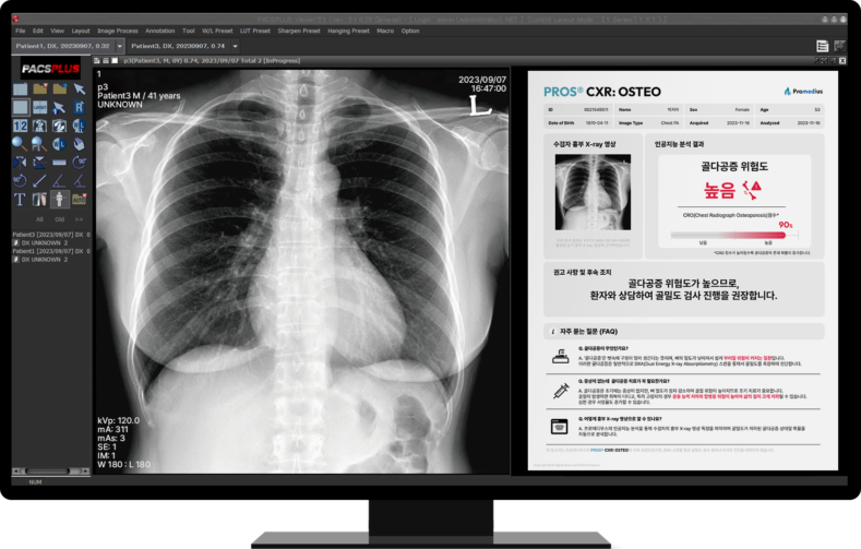 프로메디우스, 세계 최초 골다공증 진단 AI
